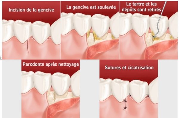 Soins Des Gencives - Dentiste Aubagne | Cabinet Dentaire Dentéclat